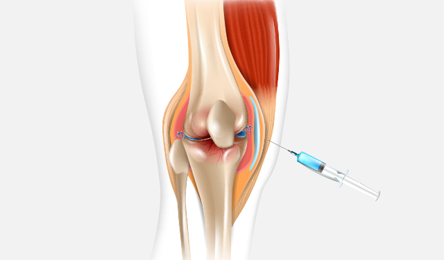 Prolotherapy