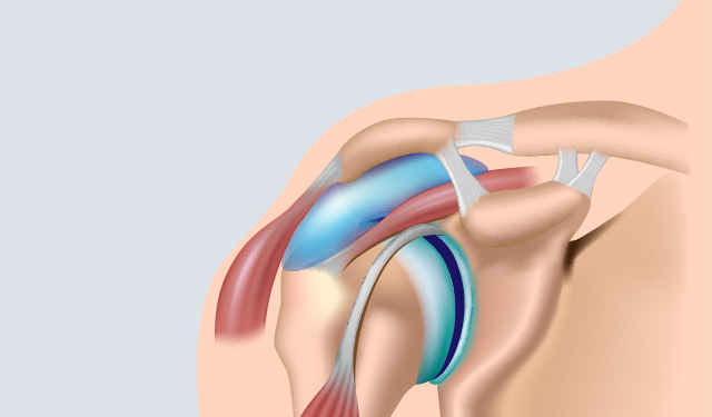 Prolotherapy